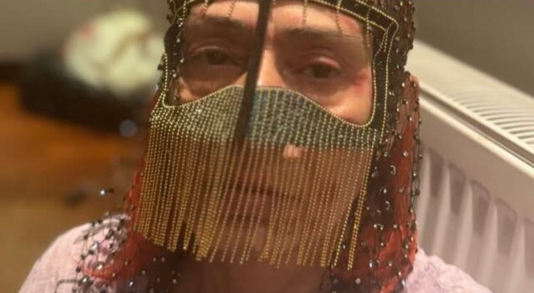 Yıldız Tilbe, Yüzündeki Yanıklar İçin Maske Taktı!